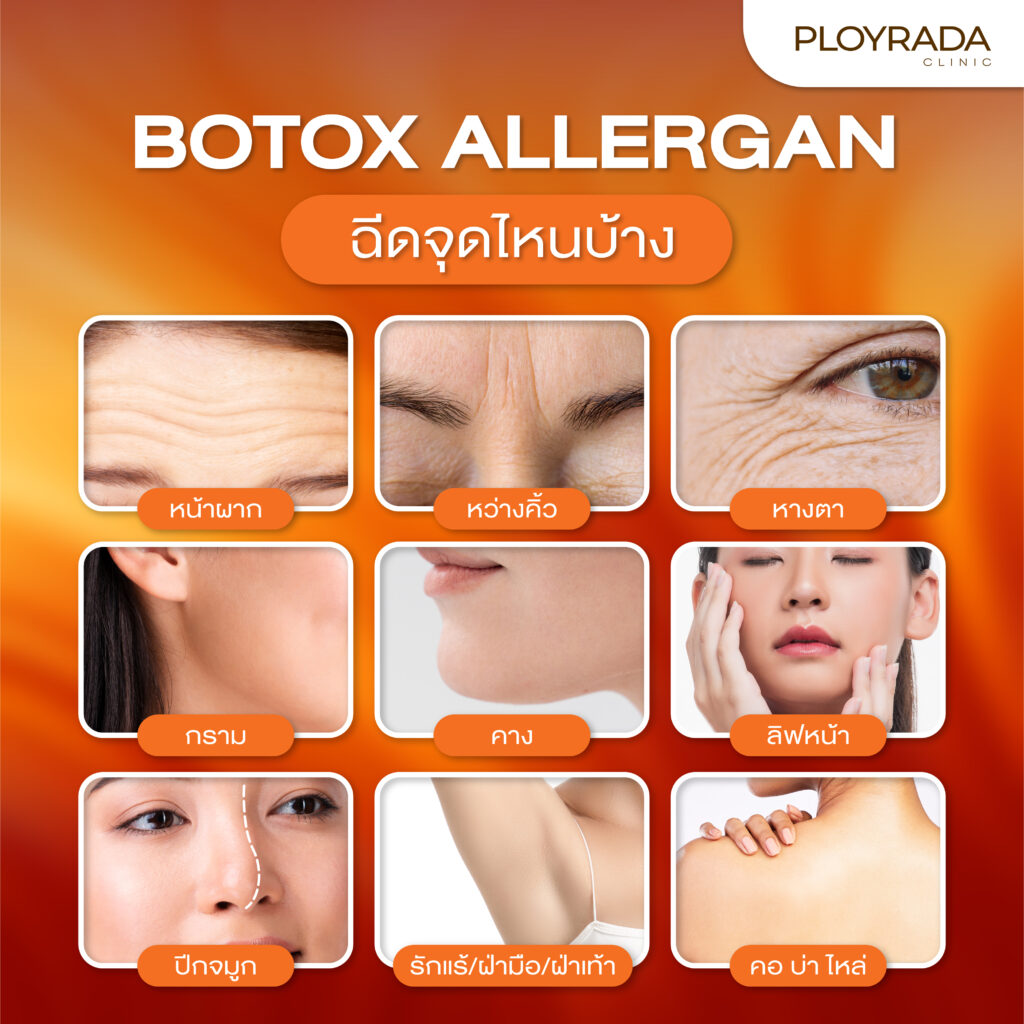 การฉีดปรับรูปหน้าด้วย Allergan ควรฉีดจุดไหนบ้าง