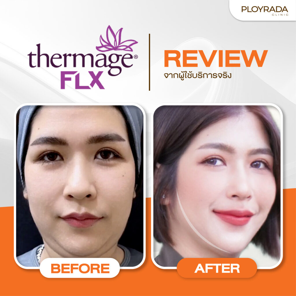รีวิว Thermage FLX ที่ Ployrada Clinic