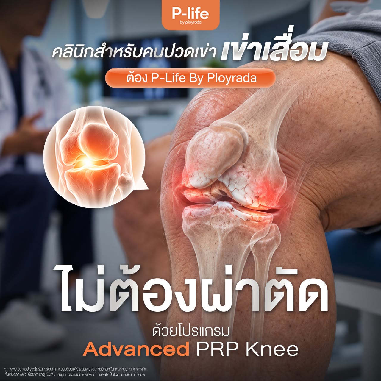 โปรแกรม Advanced PRP Knee ฟื้นฟูข้อเข่า ลดปวดเข่า ที่ Ployrada Clinic